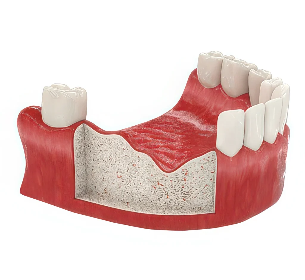 атрофия кости