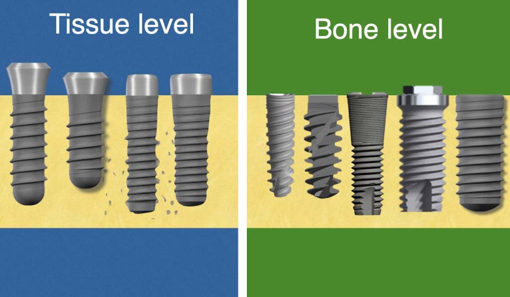 Straumann® Tissue Level Implants