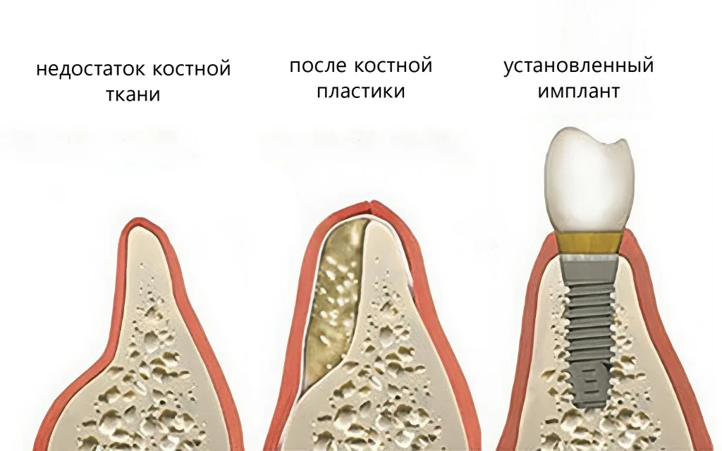 Наращивание или пластика кости
