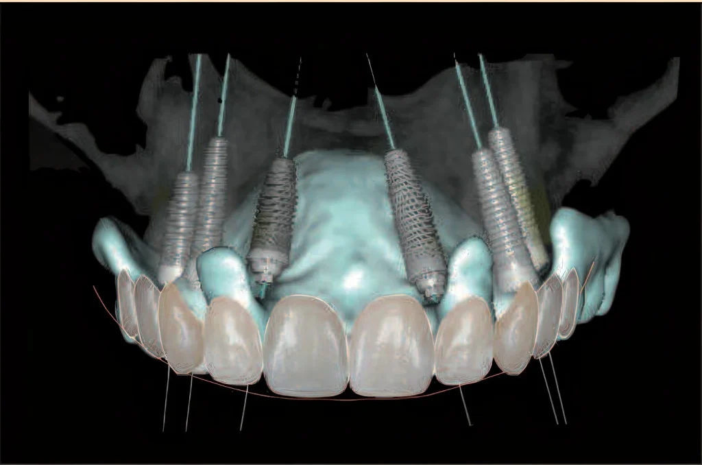 3d-планирование имплантации