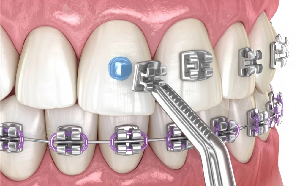 установка брекетов