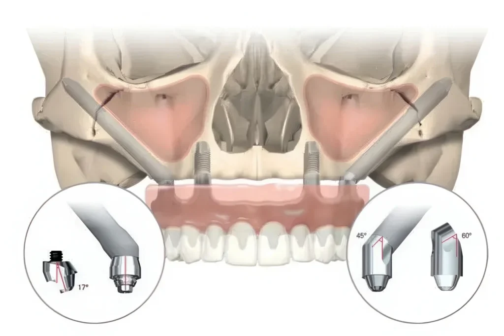 Скуловые импланты Zygoma