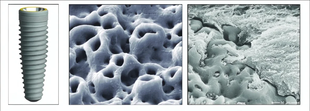 TiUnite dental implant surface