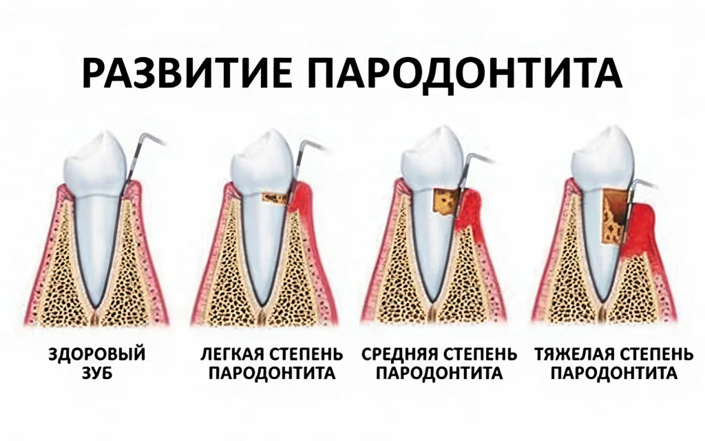 Пародонтит