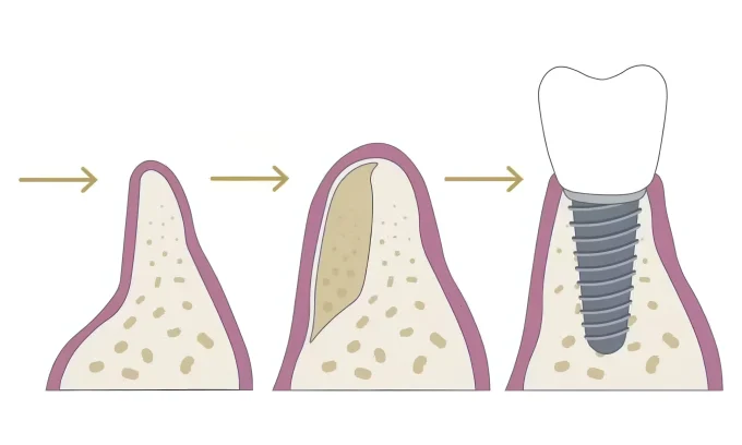 Имплантация при недостатке костной ткани: новые технологии простыми словами