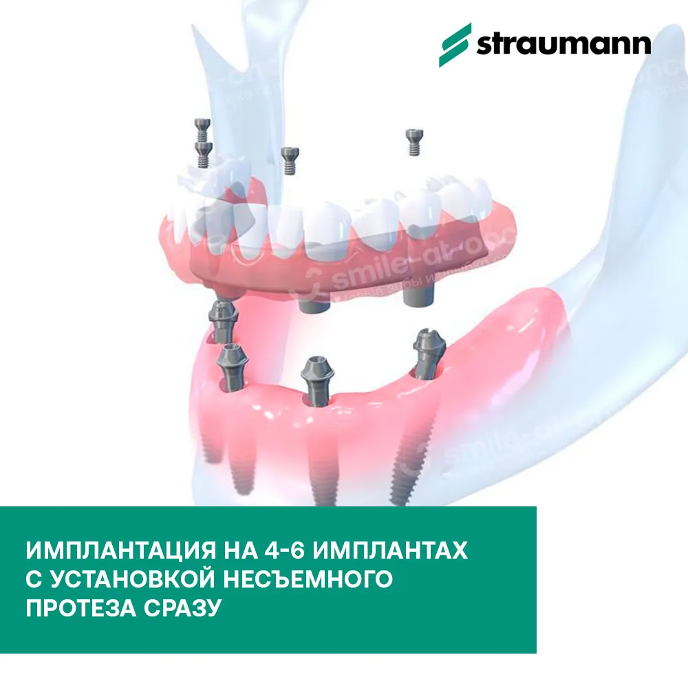 Pro Arch от Straumann