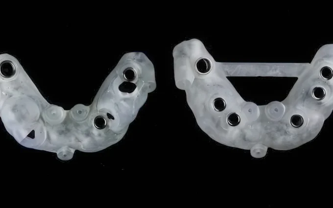 Имплантация с использованием навигационных шаблонов