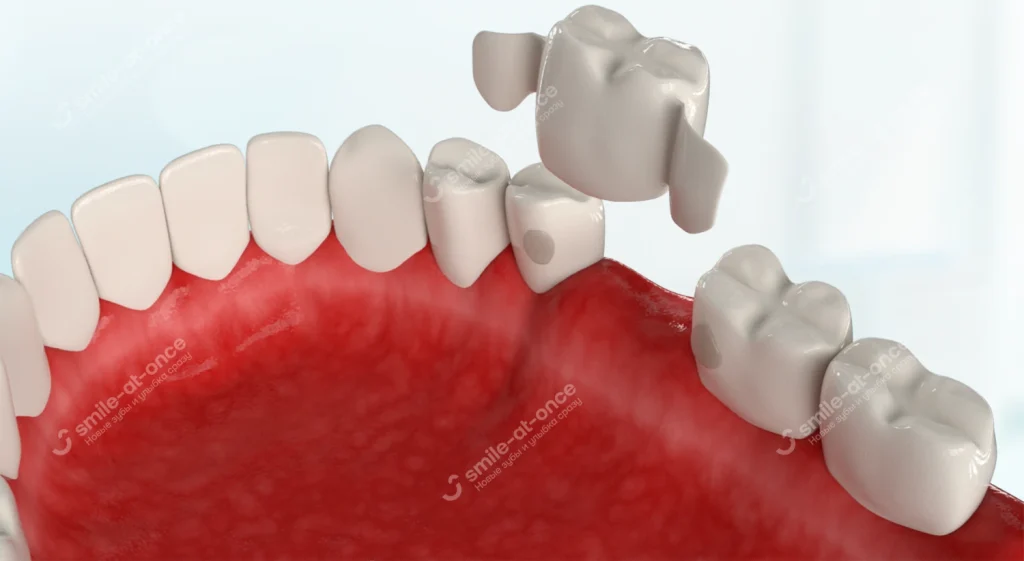 Адгезивный мост