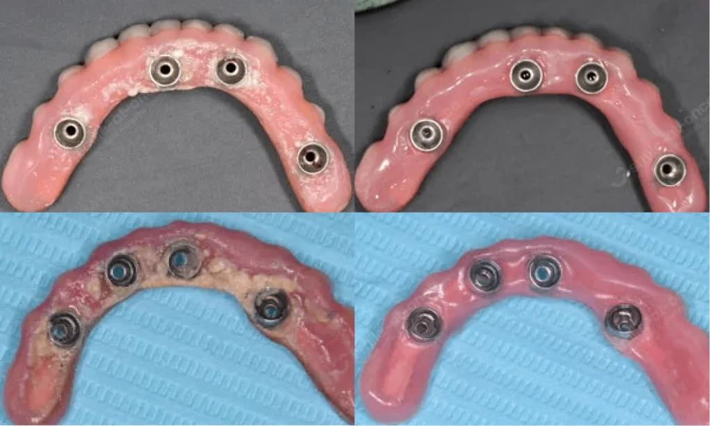 До и после профессиональной чистки протезов на имплантах