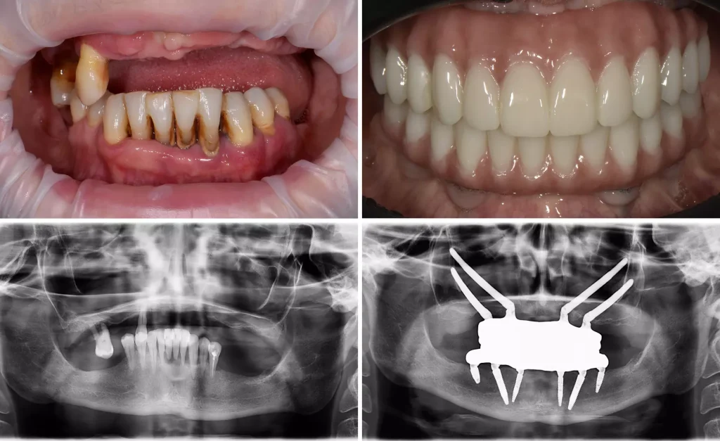 До и после имплантации зубов
