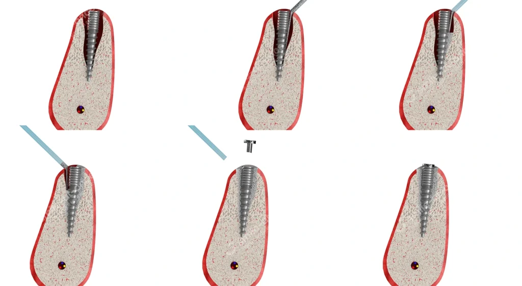 Наращивание кости