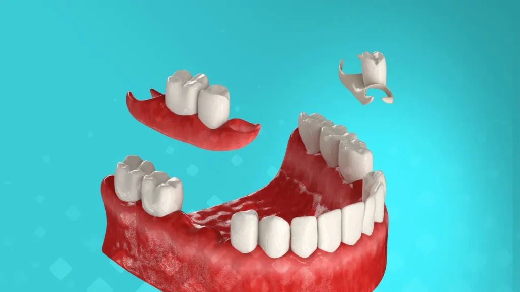 Протез бабочка