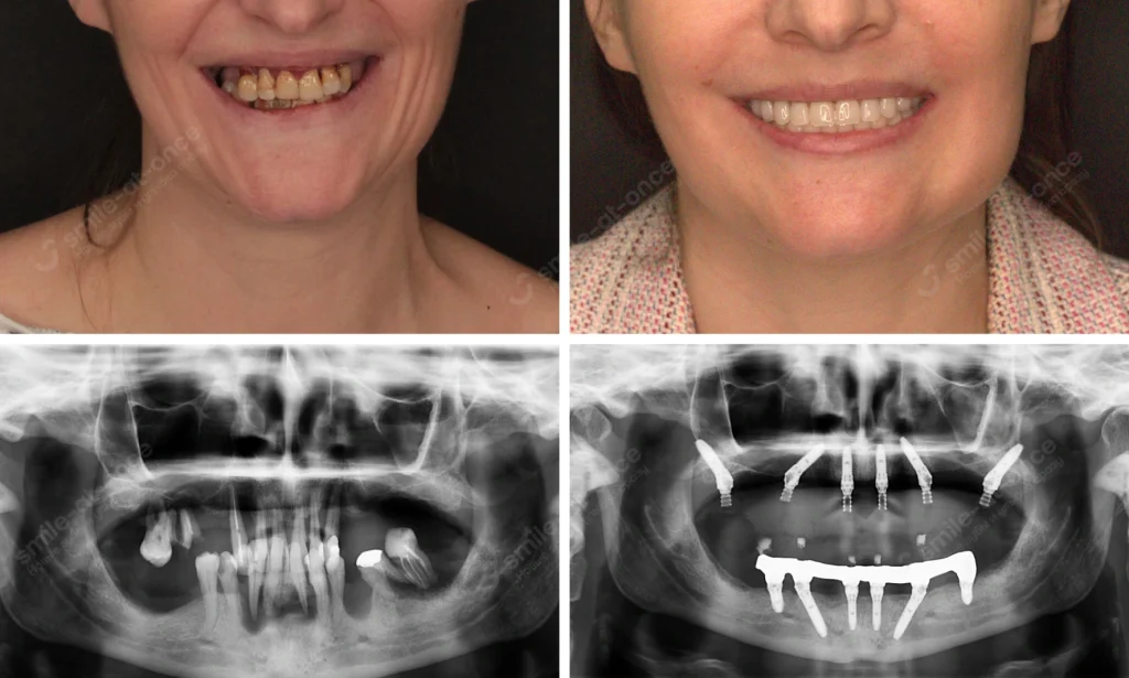 до и после имплантации